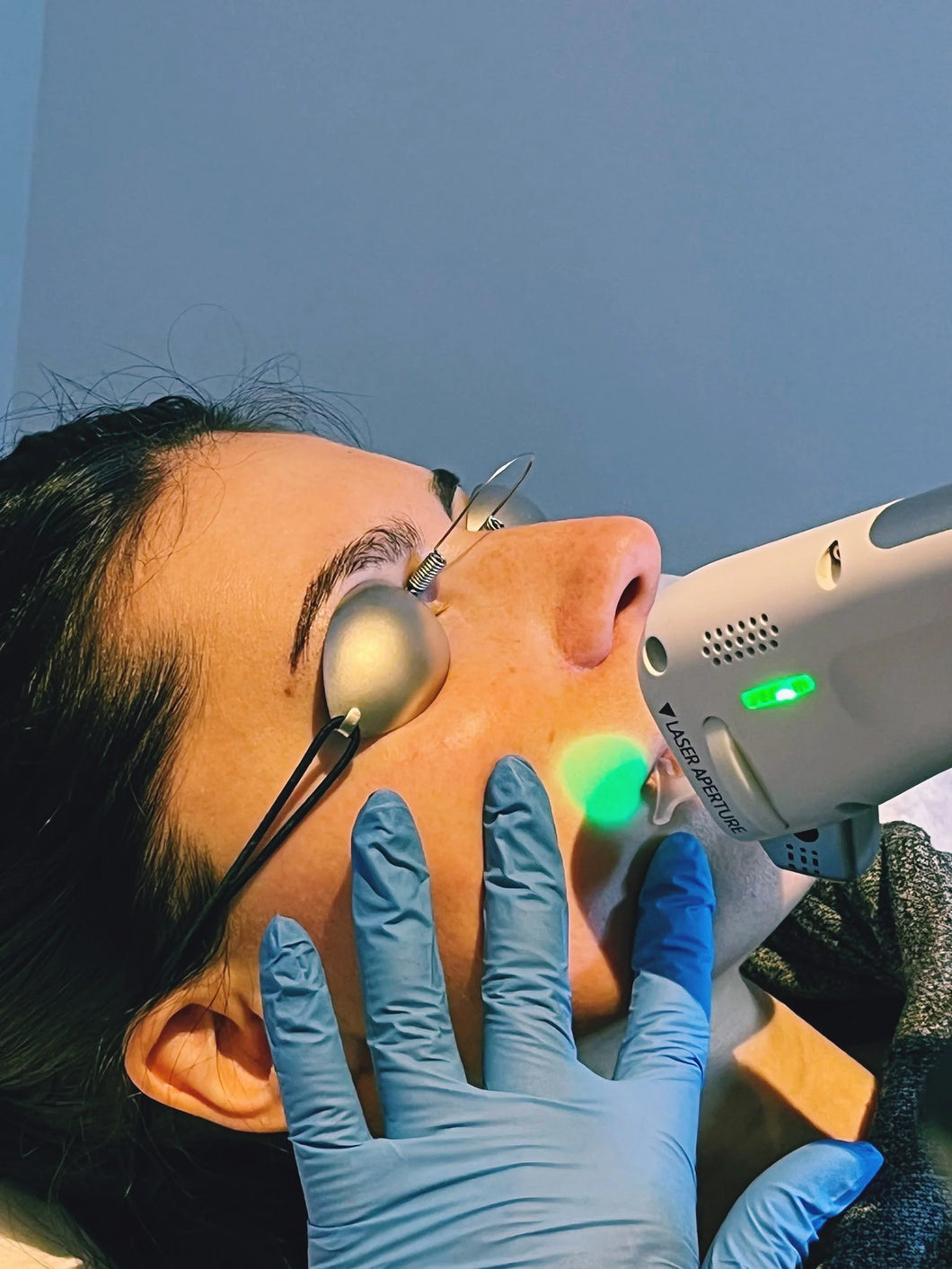 Laser Hair Removal - Full Face Package